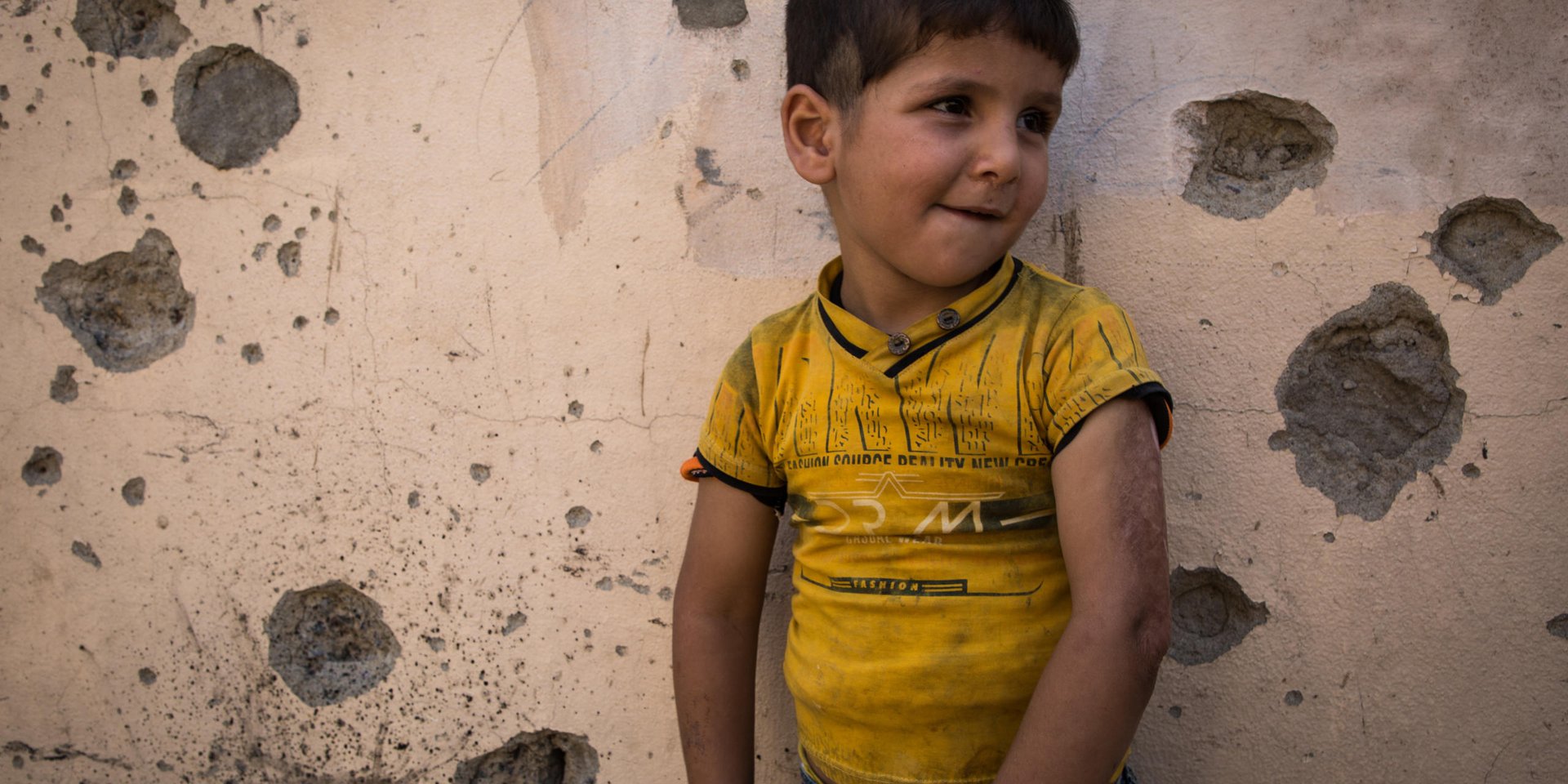 Photo : Tom Peyre-Costa

Kaiwan got his left arm burned when Islamic State group fighters attacked his neighborhood.