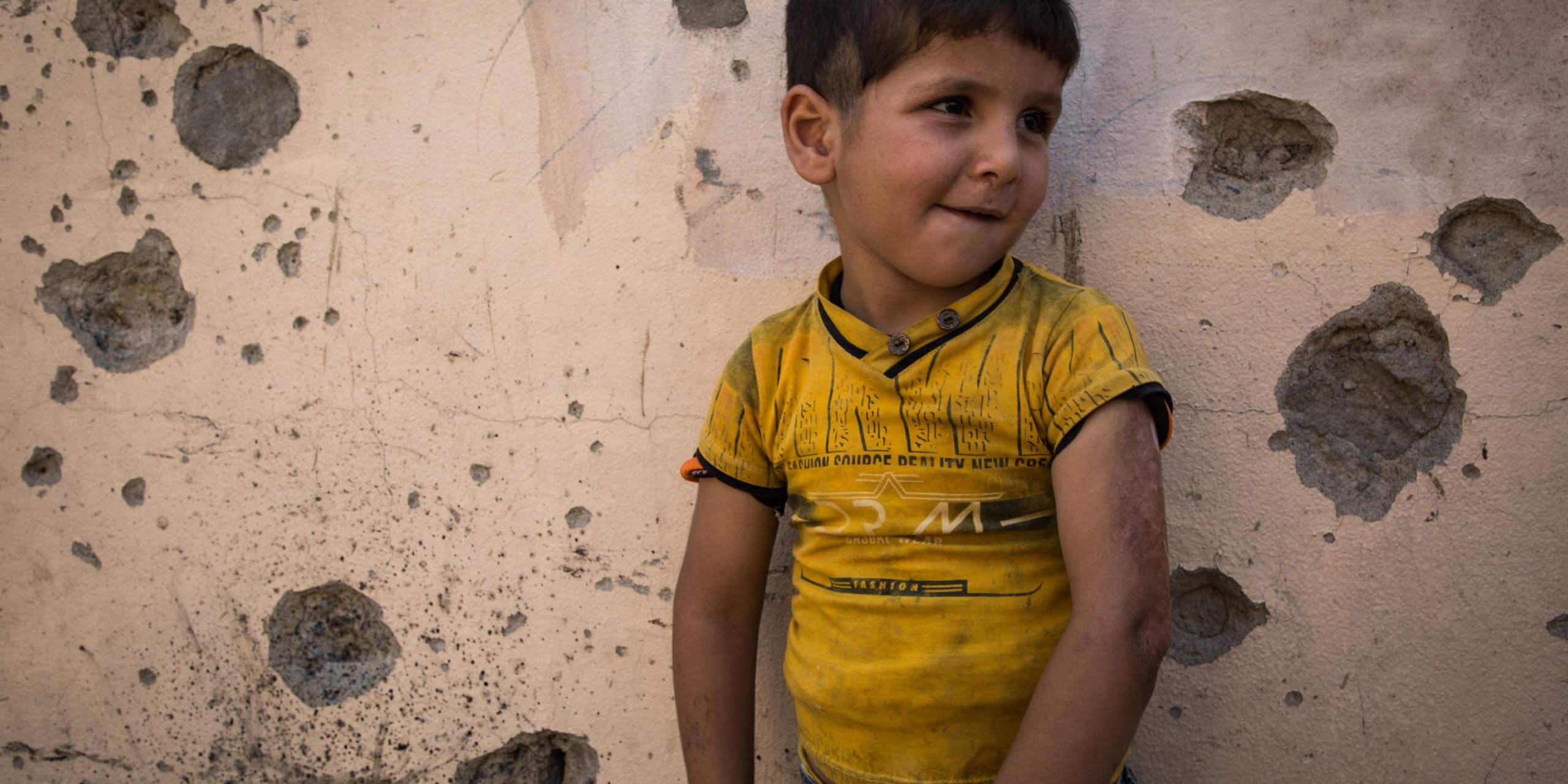 Photo : Tom Peyre-Costa

Kaiwan got his left arm burned when Islamic State group fighters attacked his neighborhood.